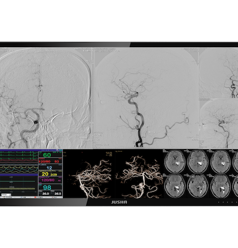 JUSHA E550EG 4K 55" Video Fusion Display System for Interventional Surgery